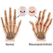 Load image into Gallery viewer, Anti-Arthritis Gloves