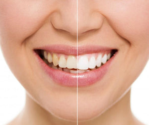 Organic Teeth Whitening